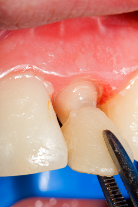 Image of a dental crown being placed at Dental Arts of Frederick in Frederick, MD.