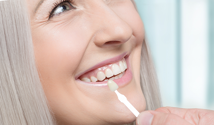 Image of a woman smiling before getting a dental veneer placed in her mouth, at Dental Arts of Frederick in Frederick, MD.